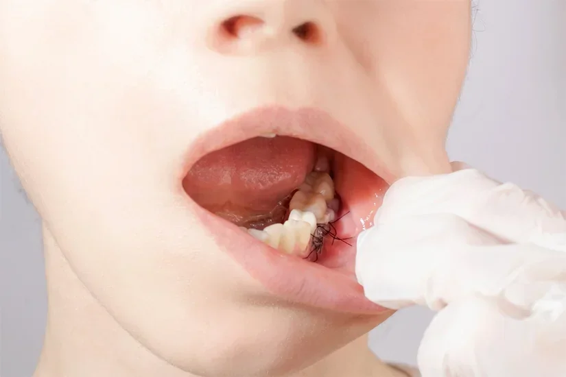Grefa gingivală – ce este și cum îmbunătățește sănătatea gingivală?