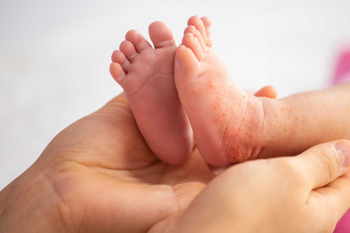 Tratament naturist pentru dermatita atopică la bebeluși!