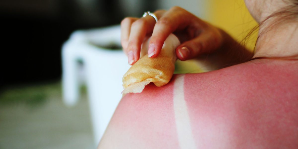Leacuri bătrânești pentru insolație, tratamente naturiste pentru arsurile solare