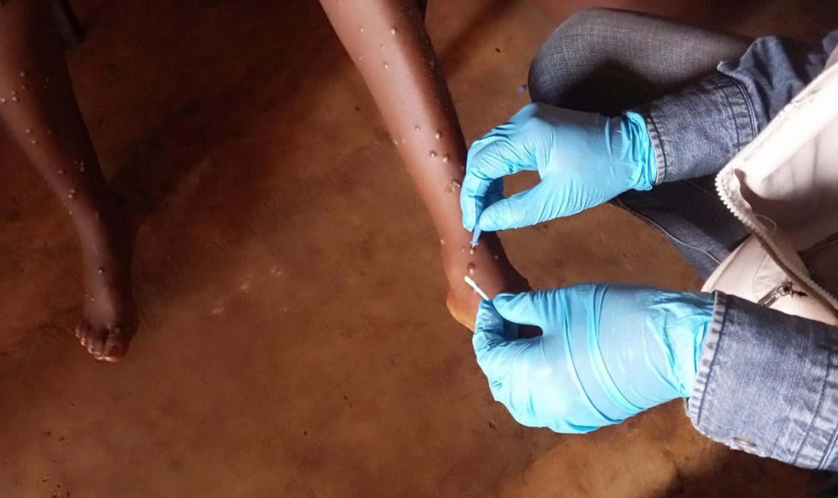 Suedia a confirmat un prim caz de mpox, o infecţie virală care se răspândeşte