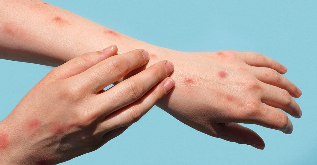 Noua tulpină a mpox dă fiori cercetătorilor. Virusul este mai contagios decât s-a preconizat