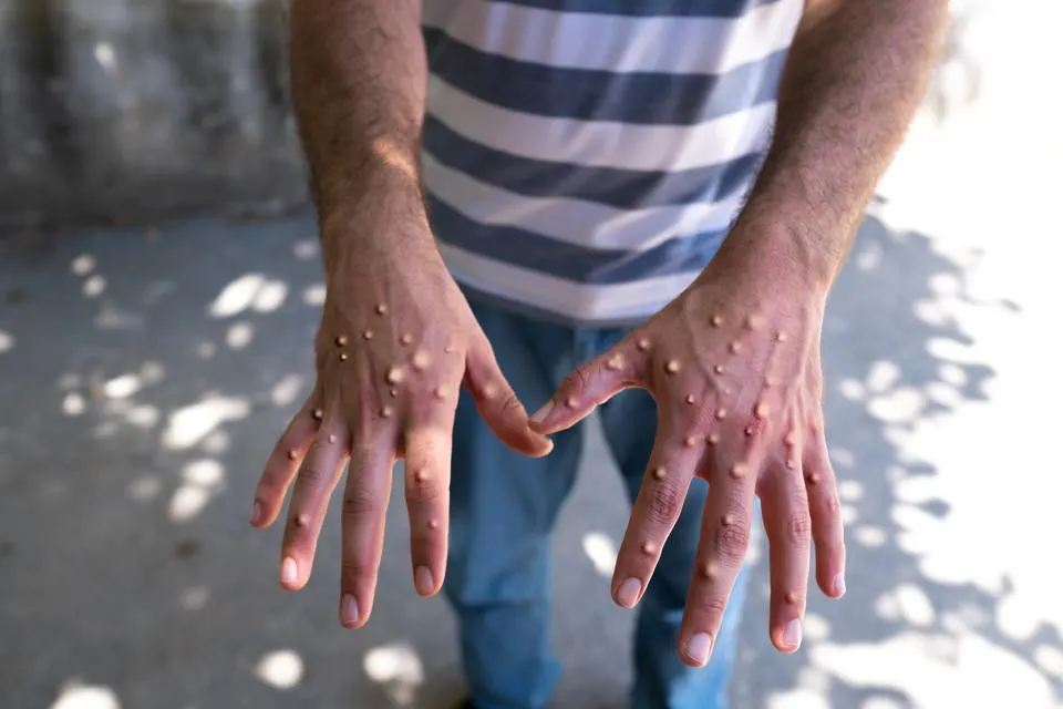 OMS declară epidemia de mpox, cunoscută ca „variola maimuței”, urgență de sănătate globală