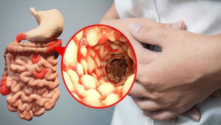 „M-am vindecat de boala Crohn”! Află care este cel mai eficient tratament