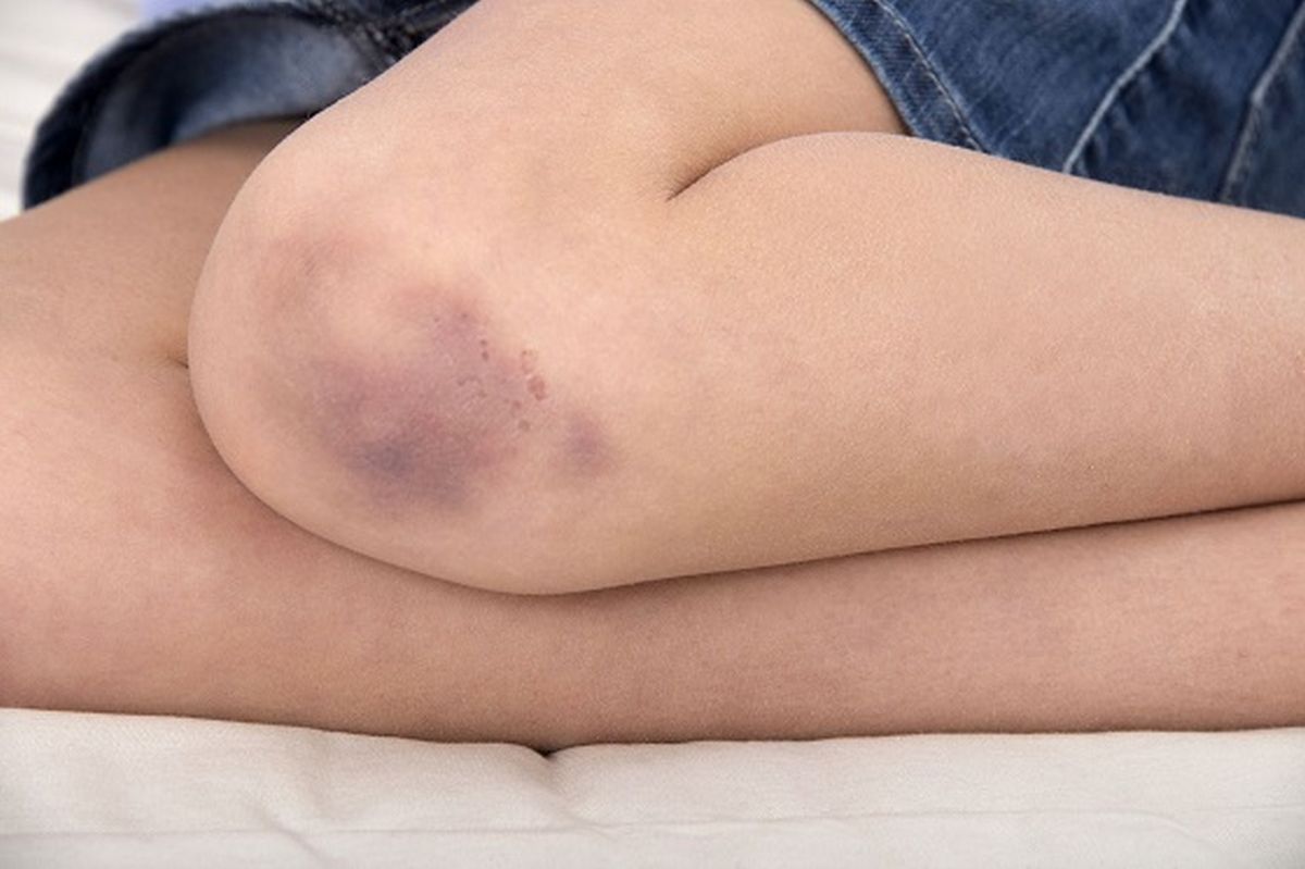 De ce apar vânătăi pe picioare fără să te lovești? Cauze și metode de prevenție