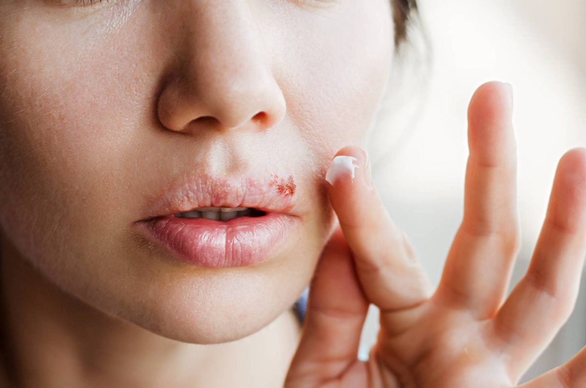 Care este tratamentul rapid pentru un herpes la buză? Poți scăpa de el în câteva ore!