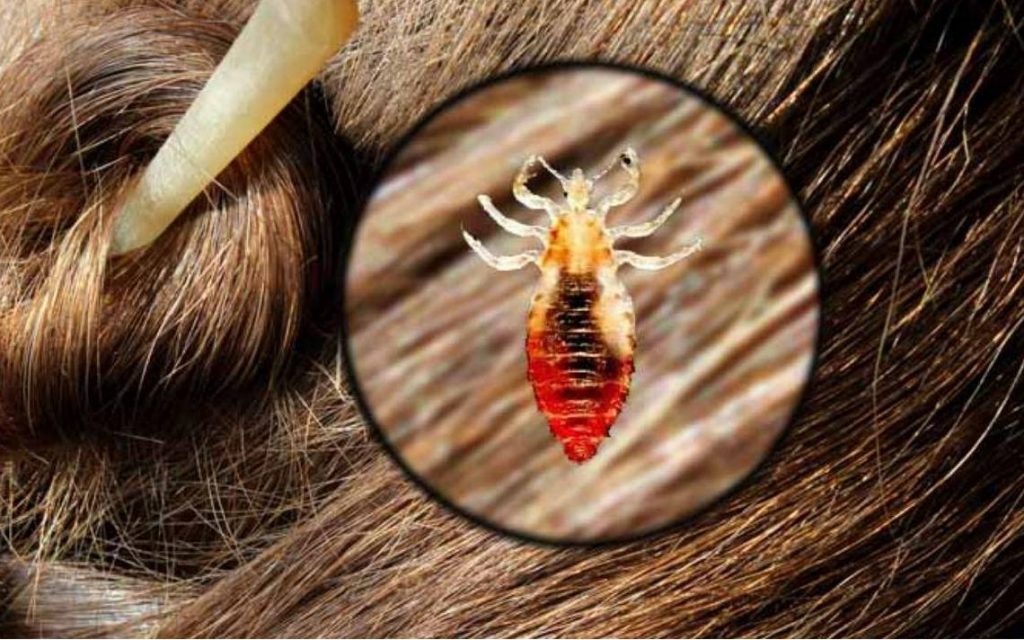 Păduchii de cap mor cu oțet? Ce trebuie să știi despre acest remediu natural