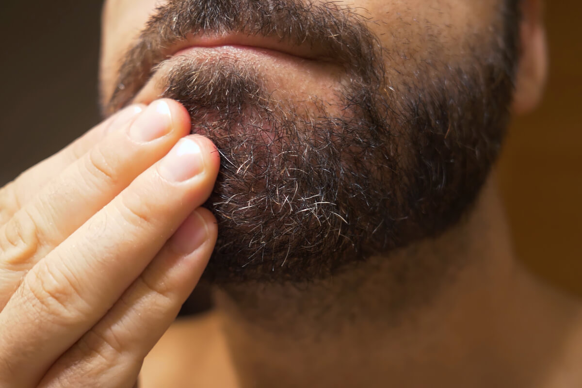 Dermatita seboreică la nivelul feței. Remedii naturiste pentru tratarea afecțiunii