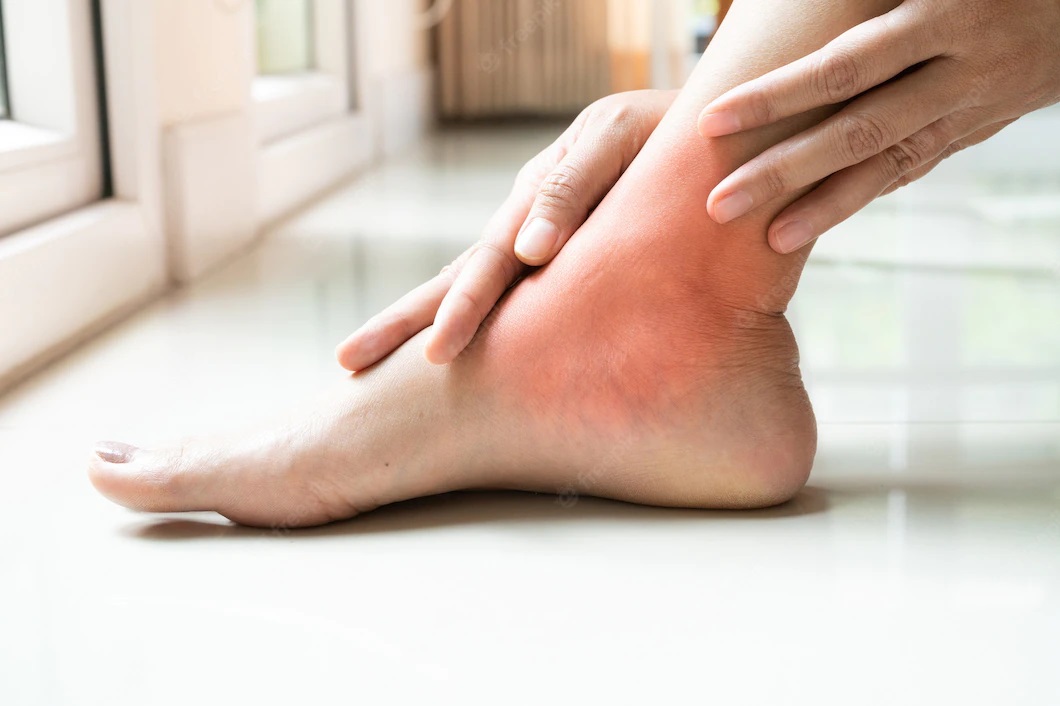 Picior umflat și ulcer varicos. Simptome, cauze și tratament
