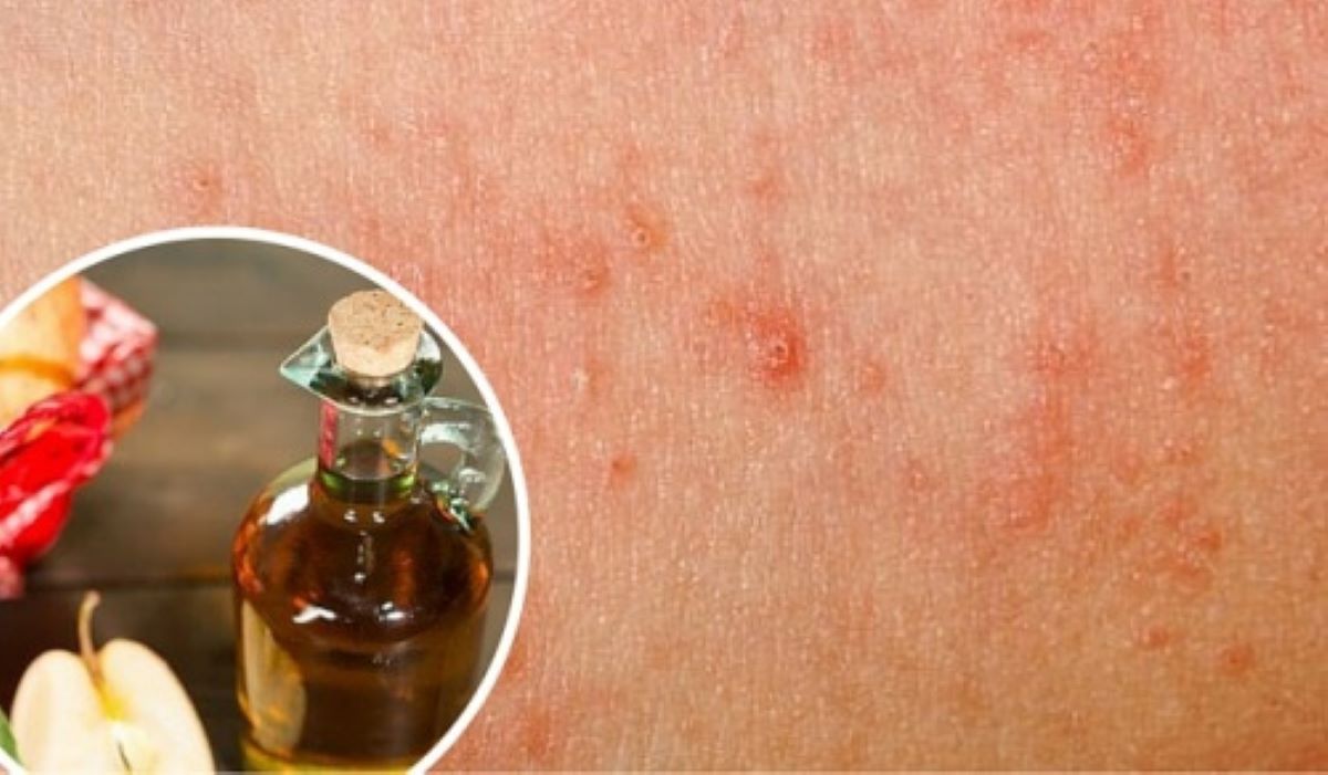 Cu această cremă naturală poți vindeca acasă ciuperca de piele! Iată cum pot fi ținute sub control aceste infecții fungice