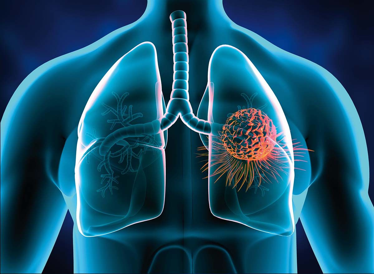 Cancerul pulmonar ar putea fi depistat din timp! Se dezvoltă testul de urină prin care se poate identificare boala înainte ca aceasta să se dezvolte