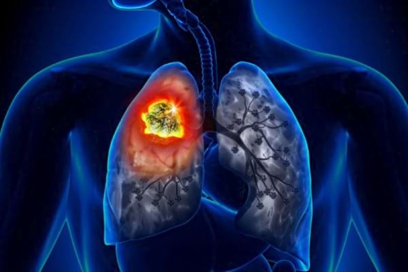 Cât se poate trăi cu metastază la plămâni? Factorii care influențează speranța de viață