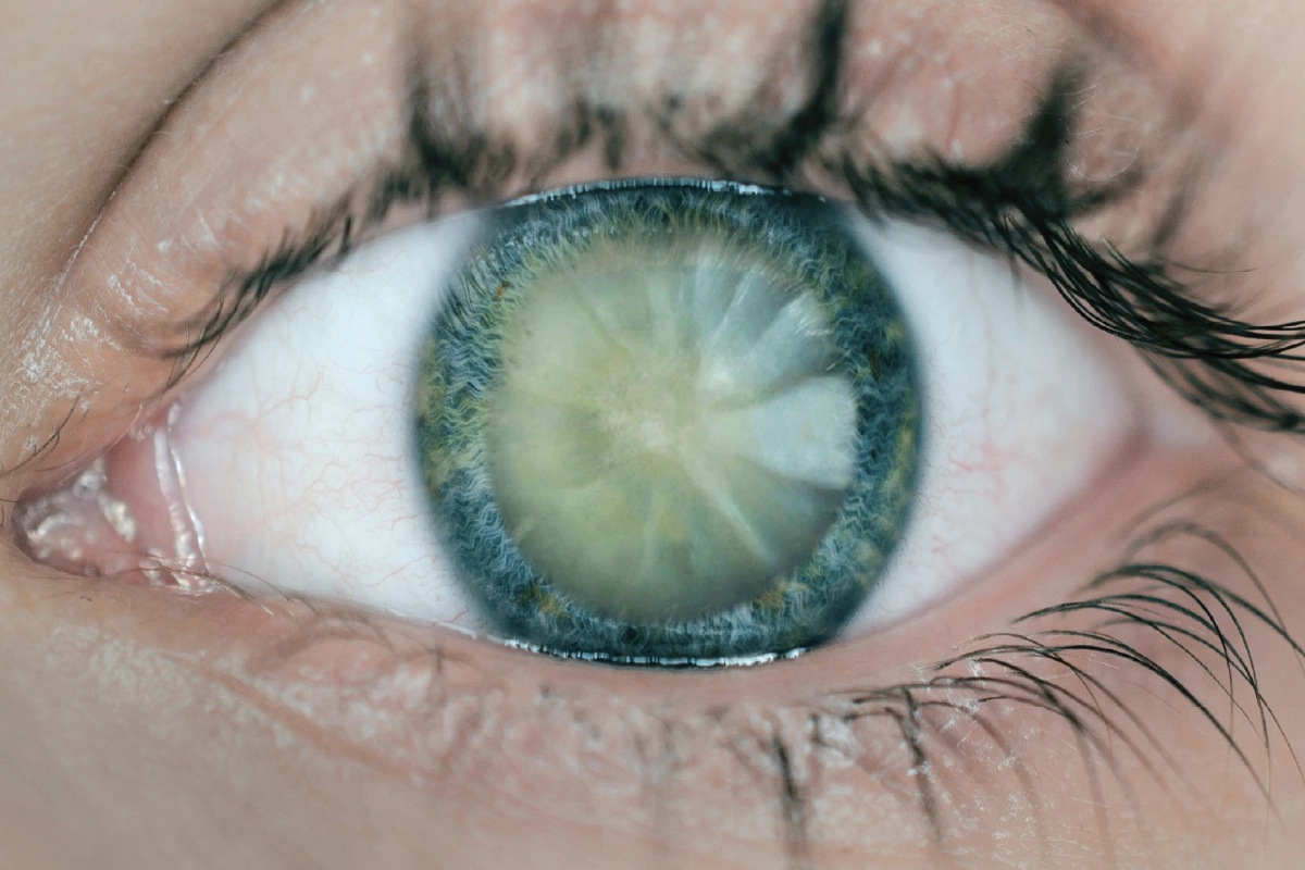 Cataractă, simptome și cauze. Ce poți face pentru a îți îmbunătăți vederea
