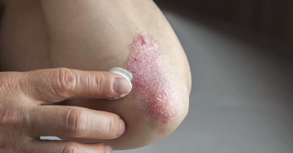 Cea mai bună cremă pentru psoriazis. Cum poți accelera procesul de recuperare