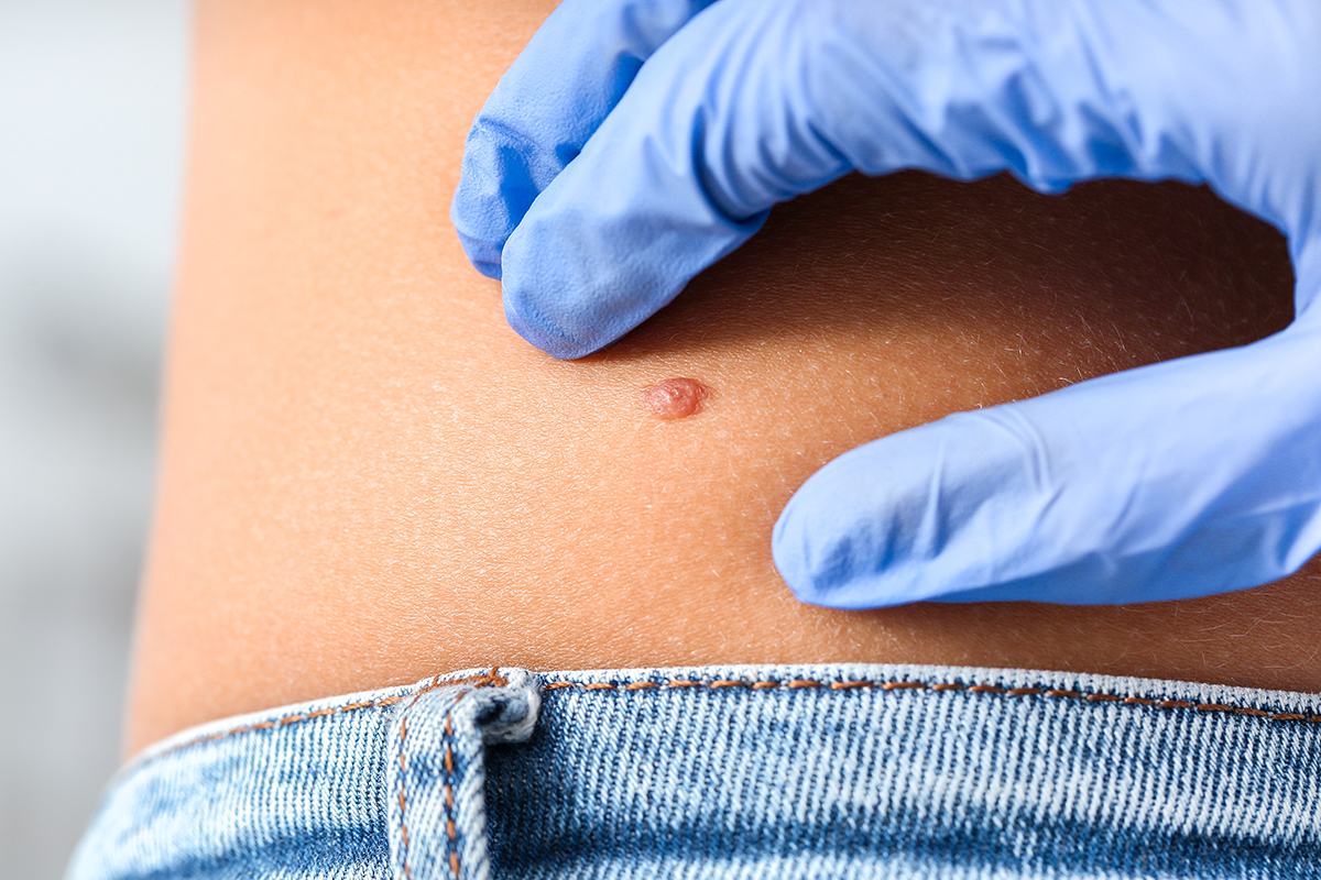 Durata de viață a pacienților cu carcinom bazocelular! Iată ce trebuie să știi despre simptome și diagnostic!