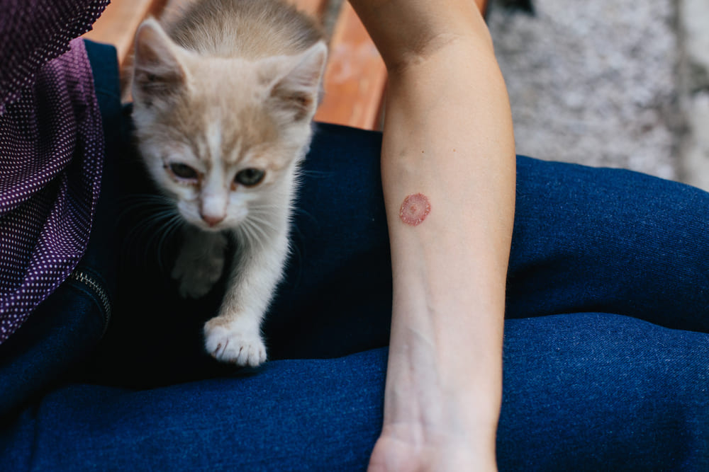 Eczema pecingine, poze. Tot ce trebuie să știi despre această afecțiune a pielii