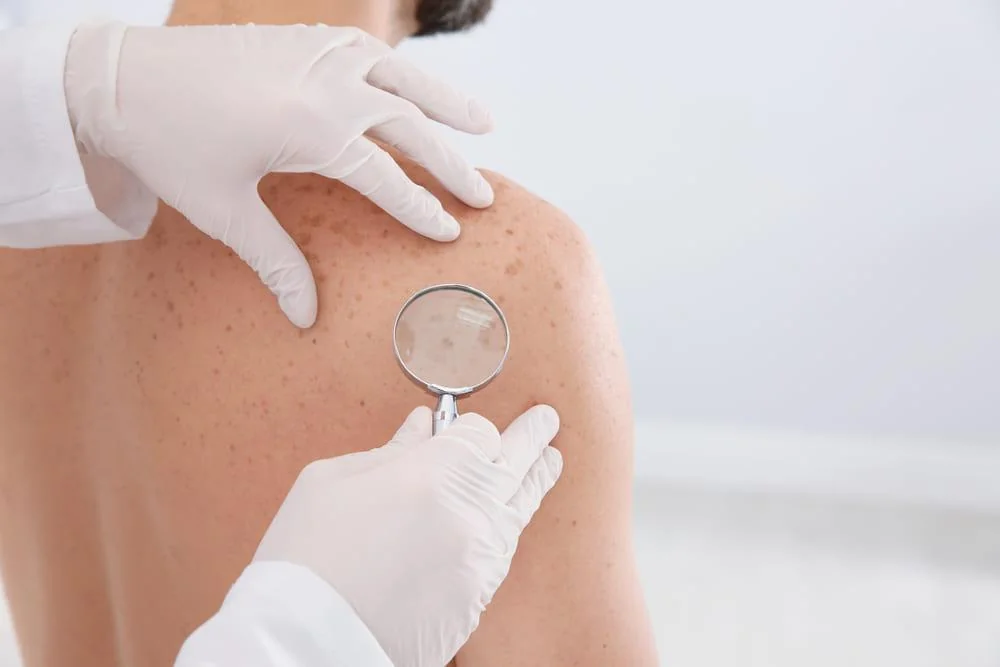Pityriasis rosea, poze. Care sunt cauzele afecțiunii și cum se manifestă