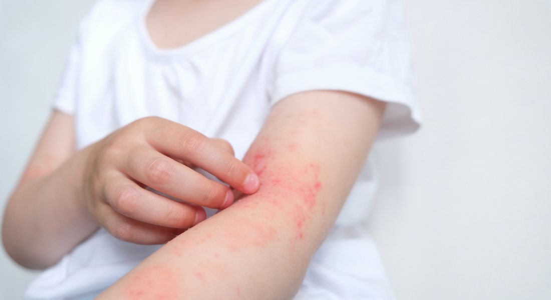 Simptome alergie. Care sunt cauzele reacțiilor imunologice ale organismului