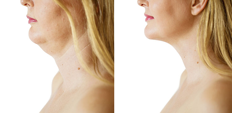 Iată cum scapi de bărbia dublă sau de gușă, antrenând mușchii feței! Modelarea feței fără chirurgie
