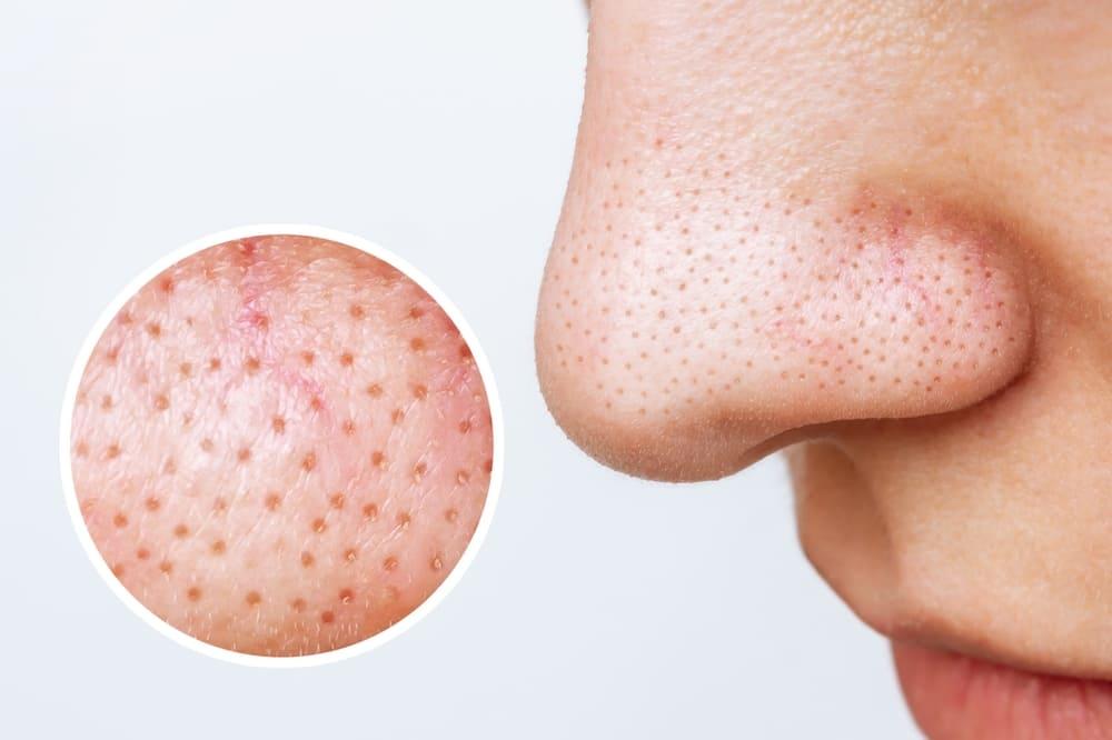 Tratamente pentru puncte negre pe care le poți face acasă! Iată cum le elimini natural!