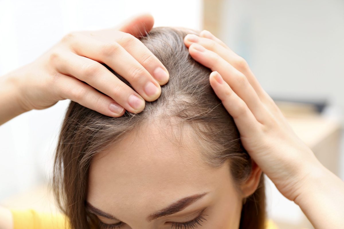 Alopecia areata. Ce poți face pentru a lupta împotriva căderii părului