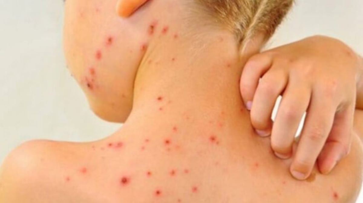 Cât durează pojarul? Simptome și prevenire