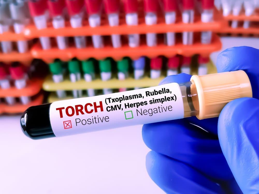 Cât costă să-ți faci un profil TORCH la Spitalul Arcadia, Clinica Sante, Synevo