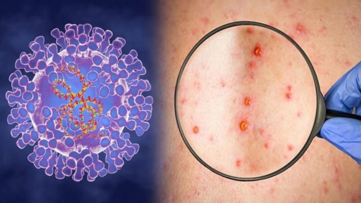 Alertă sanitară: Un nou caz de infecție cu variola maimuței confirmat în Europa