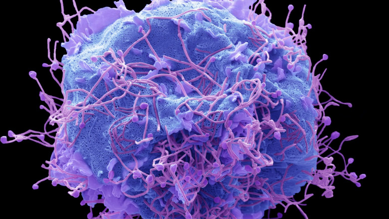 Alertă medicală: Primul caz de Metapneumovirus confirmat în România. Ce trebuie să știm