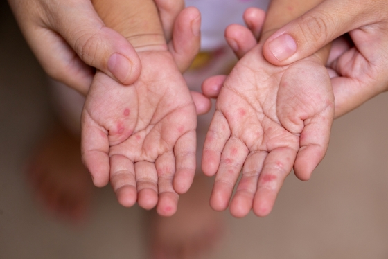 Nouă alertă sanitară: Un copil nevaccinat, victima rujeolei. Epidemia se extinde rapid