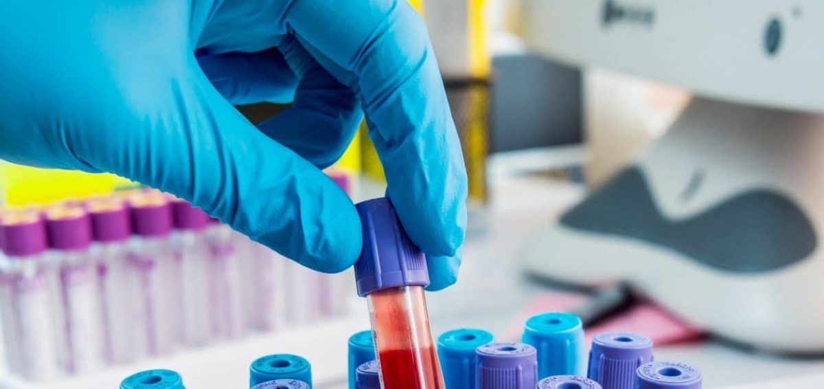 Ce valori ale analizelor indică leucemie? Iată care sunt testele de confirmare ale diagnosticului!