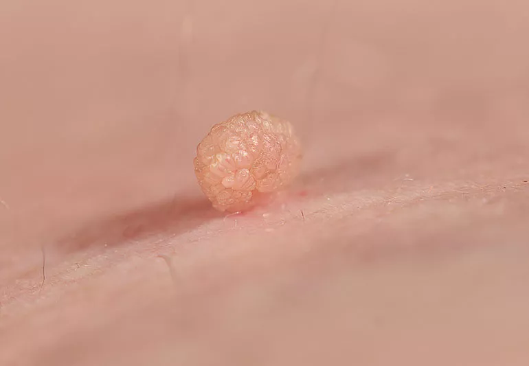 Ce poți face atunci când ai carne crescută în zona genitală – poze. Ce virus cauzează afecțiunea și cum poți elimina disconfortul
