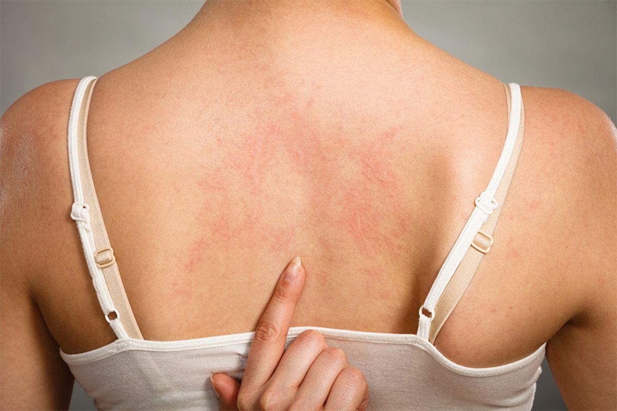 Cât durează o alergie de piele? Cum le tratezi