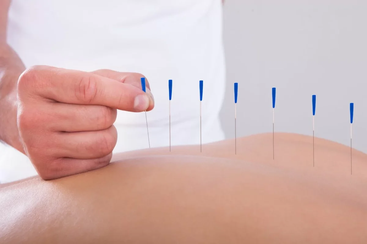 Ce boli tratează acupunctura. Cum funcționează și când este recomandată procedura
