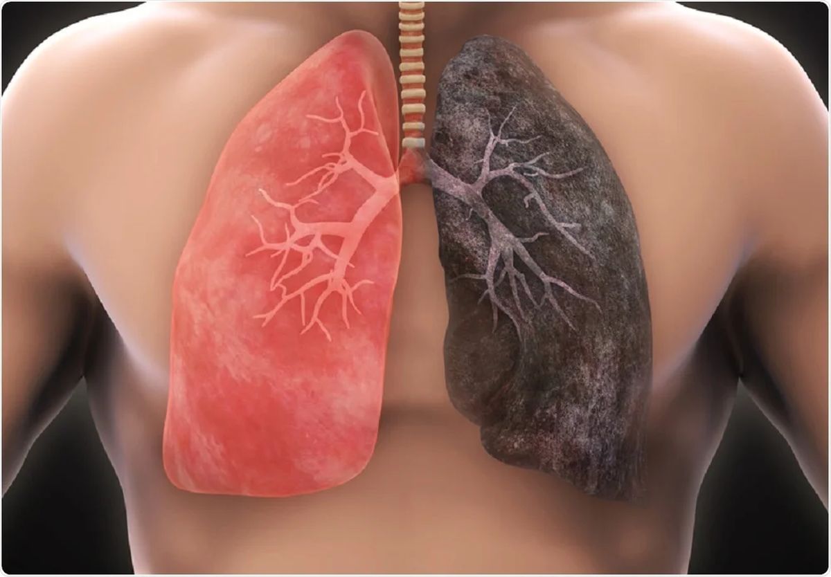 Cancer la plămâni – Simptome, cauze și diagnostic