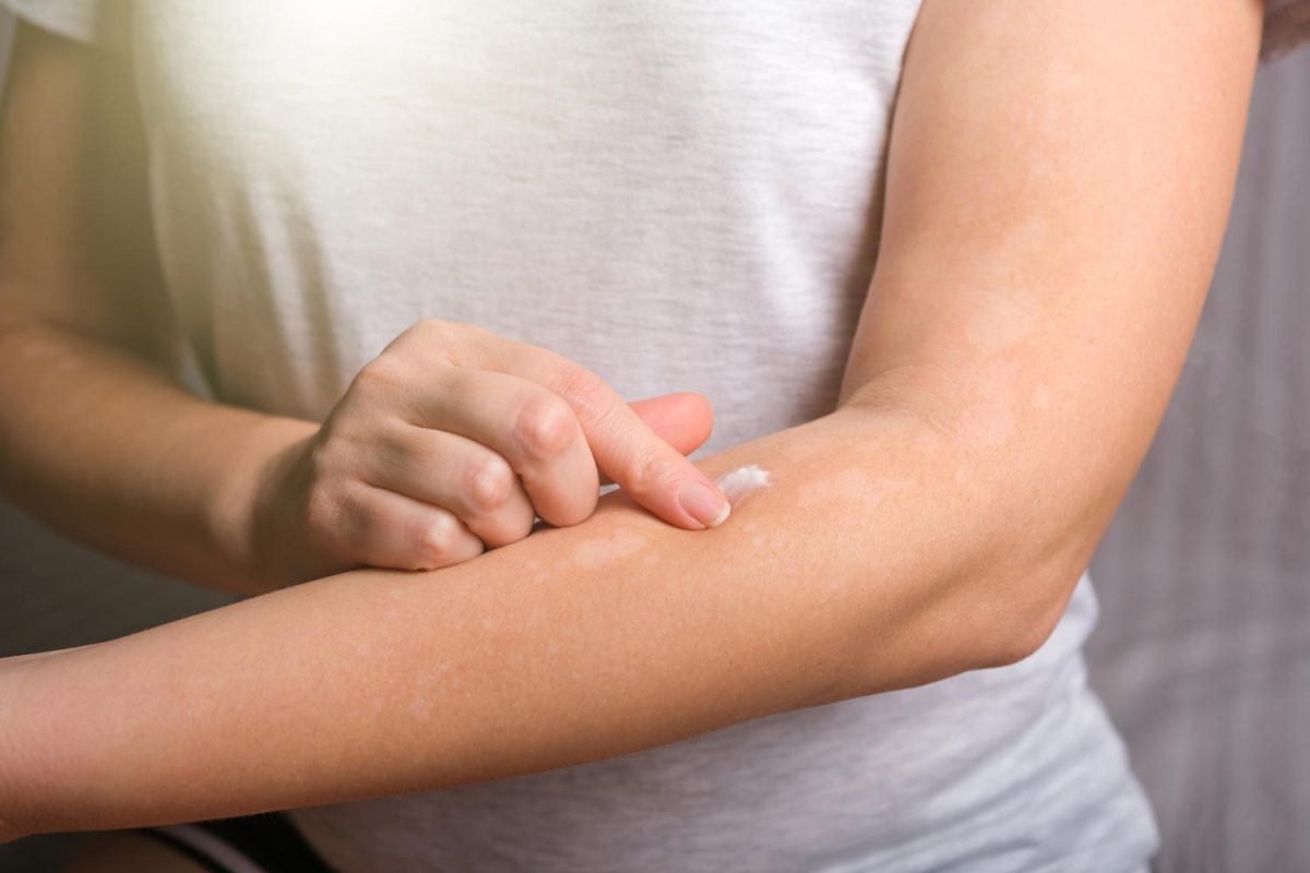Ce este hidrocortizonul și pentru ce se folosește. Ce trebuie să știi înainte de a utiliza hidrocortizon și care sunt posibilele reacții adverse
