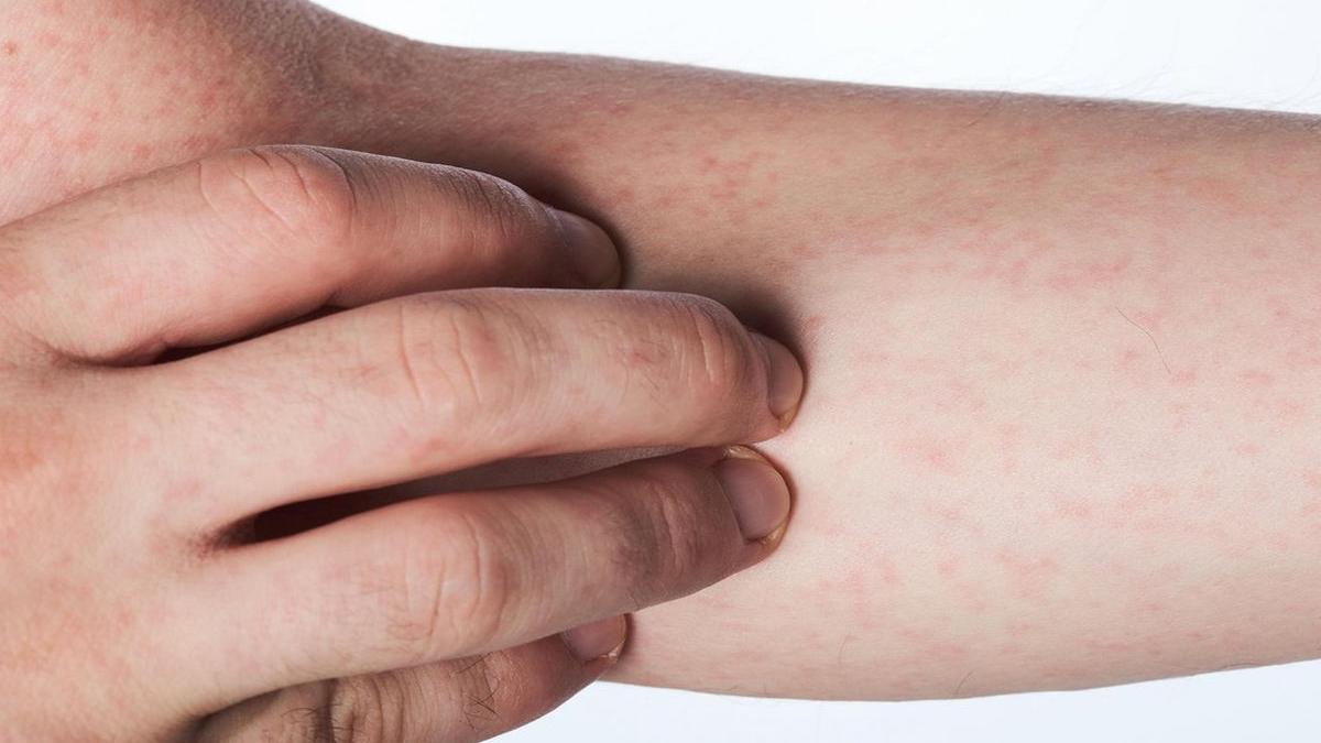Cazurile de rujeolă în Europa au crescut de peste zece ori în ultimul an, iar medicii fac apel la vaccinare. Cel mai mare focar este în România