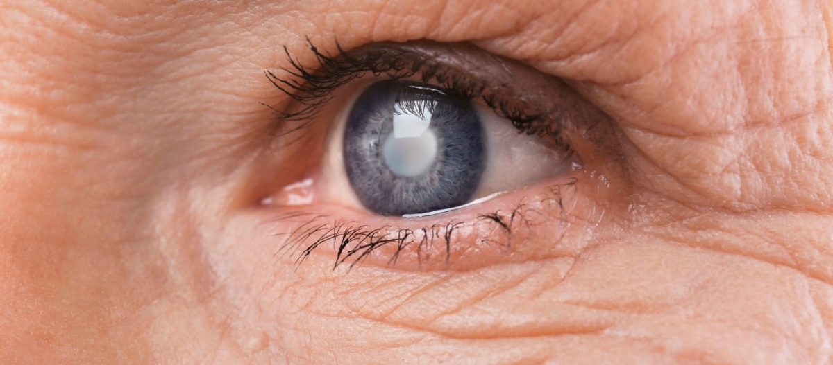 Cât costă operația de cataractă pentru pensionari? Află toate detaliile