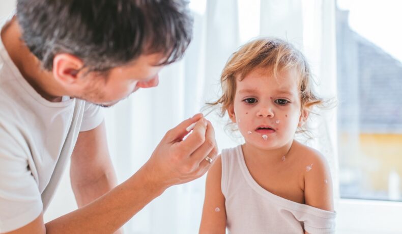 Ce remedii calmează mâncărimea la varicelă? Află de ce adulții fac forme mai severe!