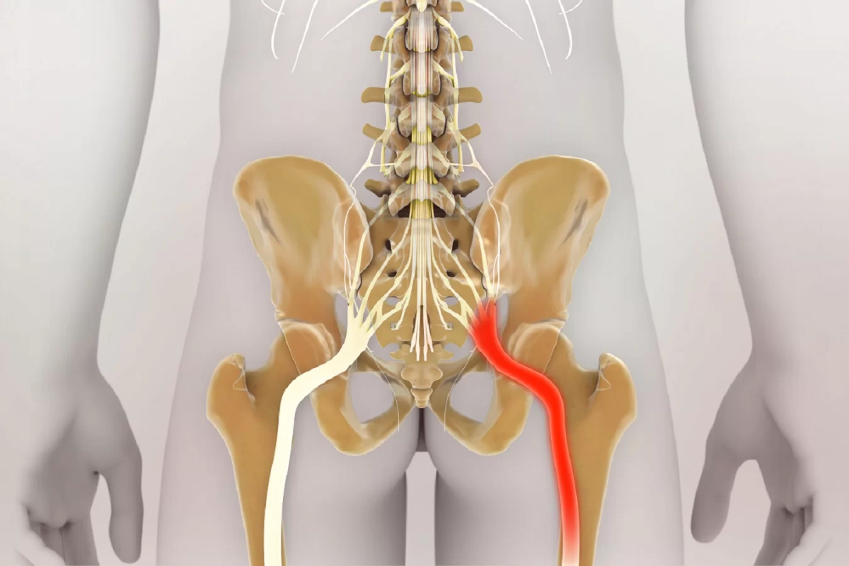 Unde se află nervul sciatic? Află tot ce trebuie să știi despre acesta