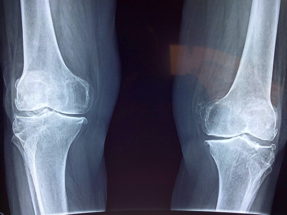 Radiografia de genunchi – În ce situații se face și cum se efectuează procedura?