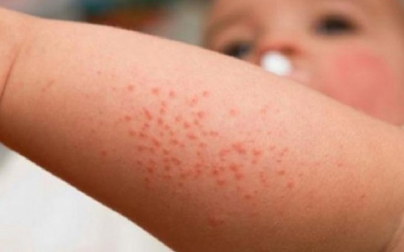 Rujeola revine în forță în SUA, dar miturile despre vaccin o sabotează. Un sfert dintre părinți au amânat imunizarea copiilor