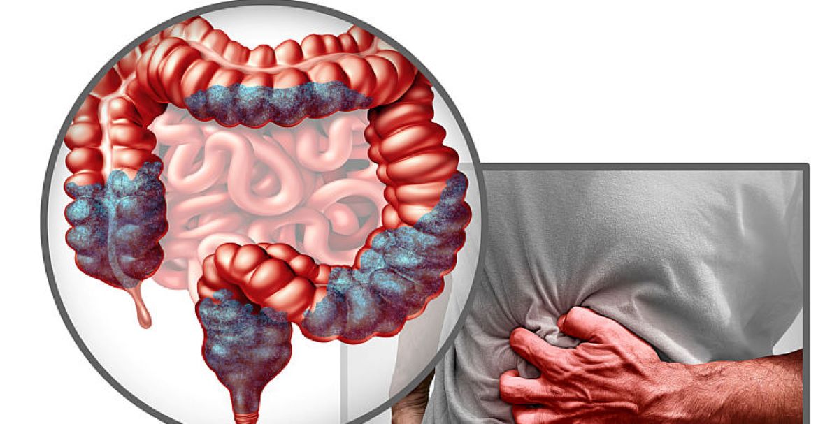 Primele simptome ale cancerului colorectal! Ce ar trebui să știm pentru a-l preveni