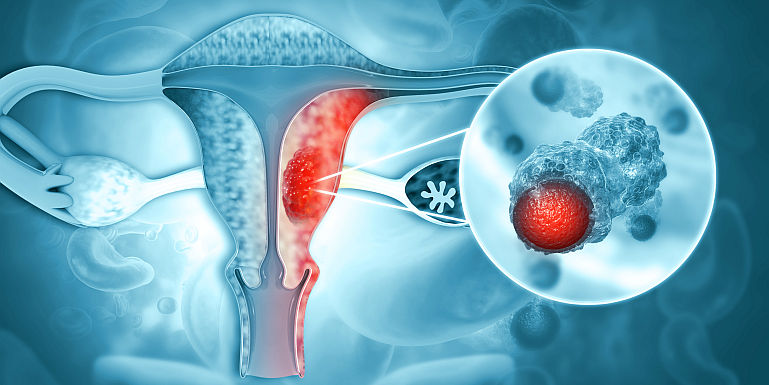 În cât timp se dezvoltă cancerul ovarian? Iată cum poți preveni această afecțiune!