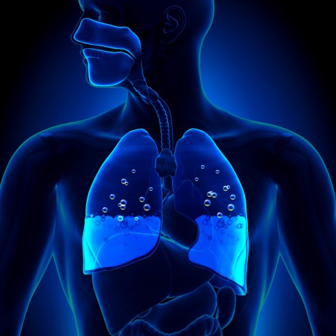Edem pulmonar. Șanse de supraviețuire și cât de grave sunt simptomele