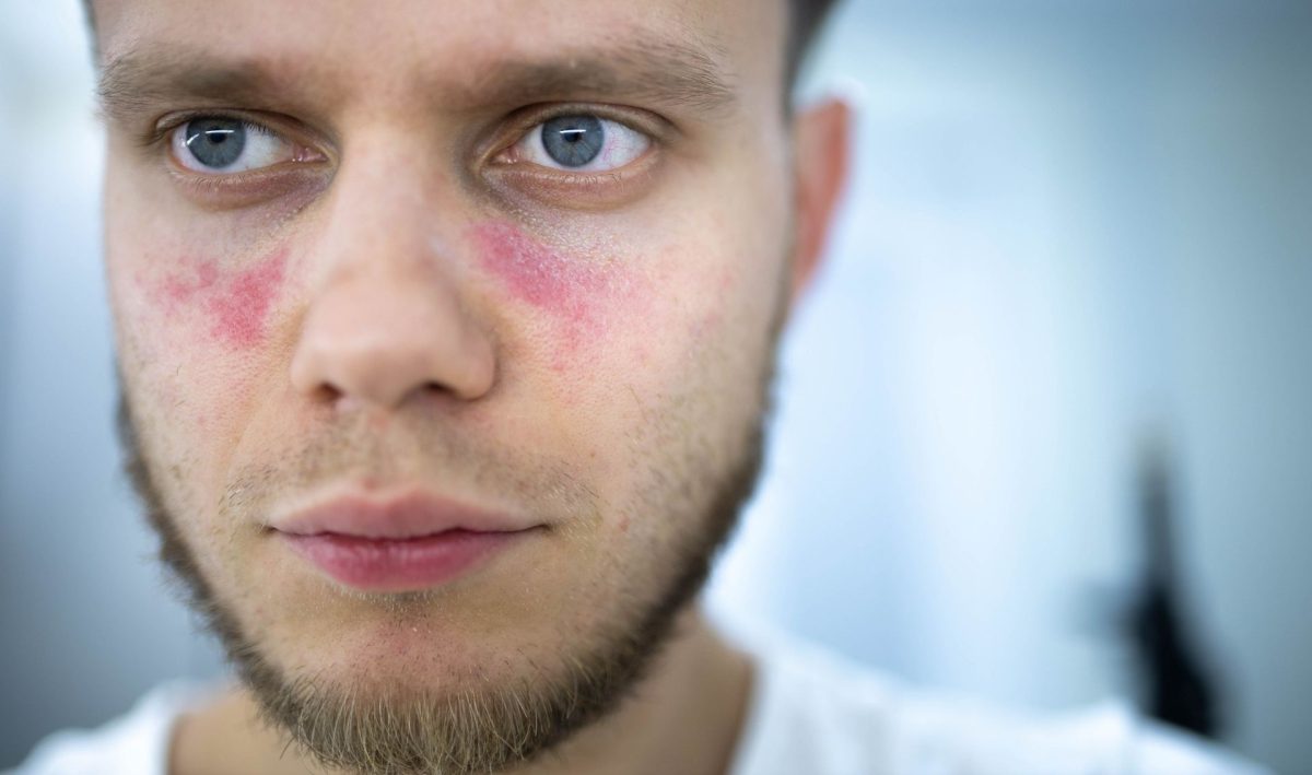 Lupus eritematos sistemic, boala diagnosticată mult prea târziu! Iată ce simptome „trădează” această afecțiune!