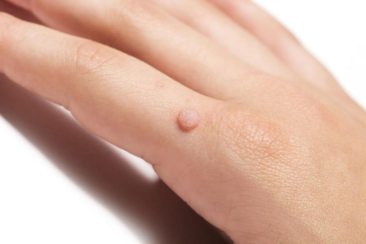 Cum se tratează veruca vulgară? Manifestări clinice produse de infecția cu virusuri HPV!