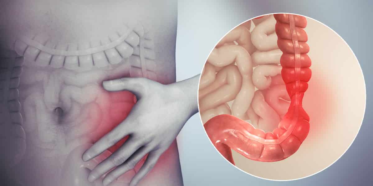 Ce este sindromul intestinului iritabil? Iată ce complicații pot apărea!