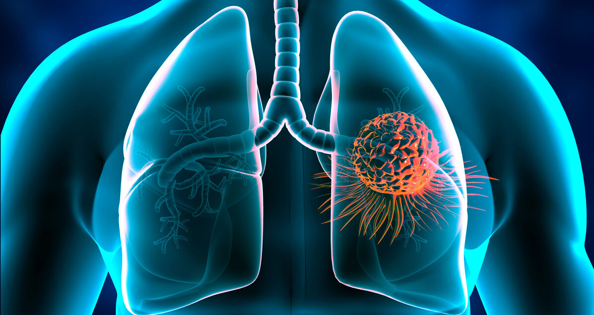 Ce este un abces pulmonar? Află ce consecințe poate avea asupra sănătății!