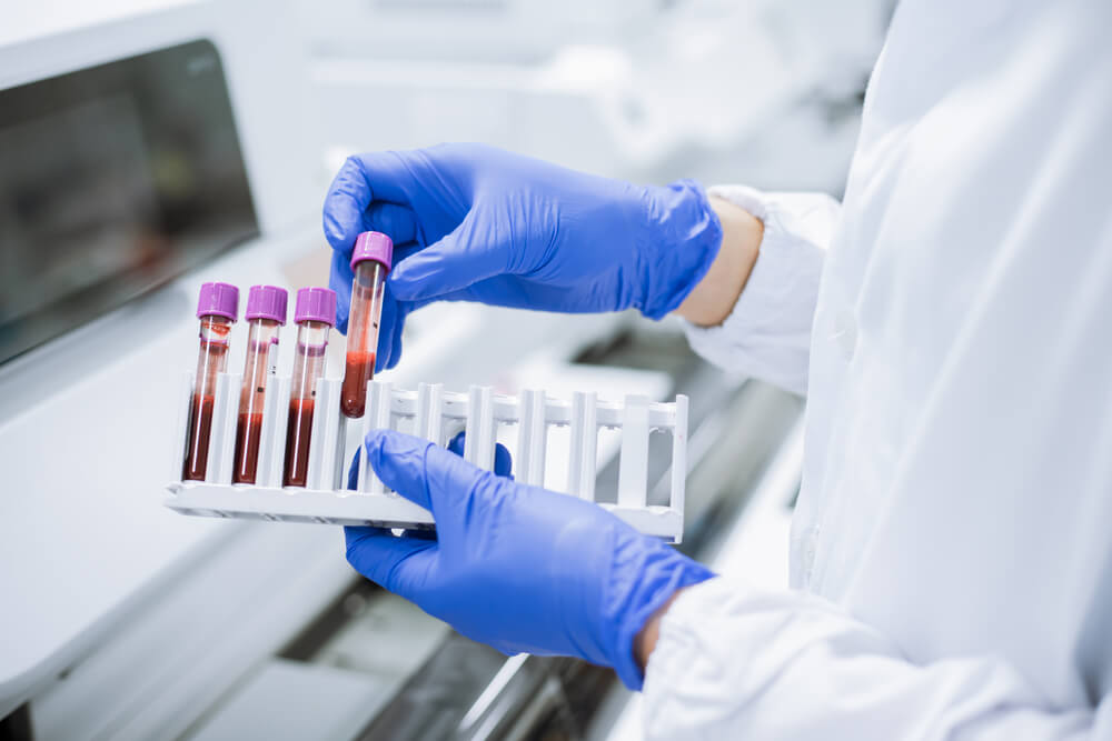 Pot analizele de sânge să depisteze scleroza multiplă? Iată ce trebuie să știi pentru diagnostic