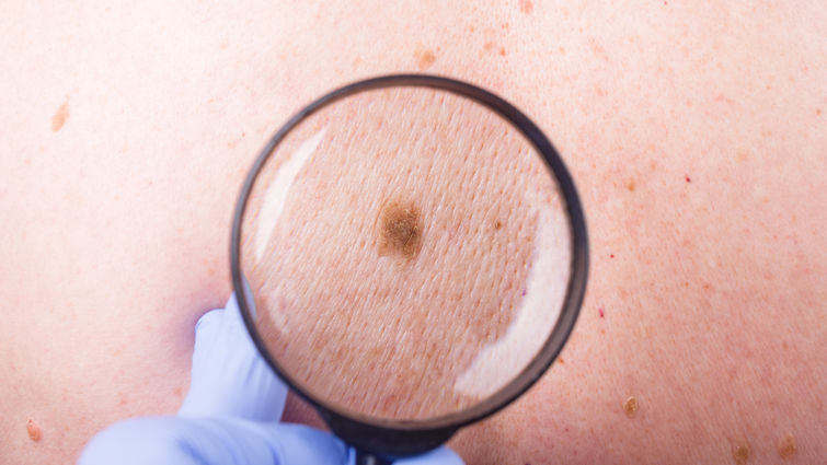 Cancerul, cea mai frecventă cauză de deces în lume. Care sunt factorii care duc la această boală